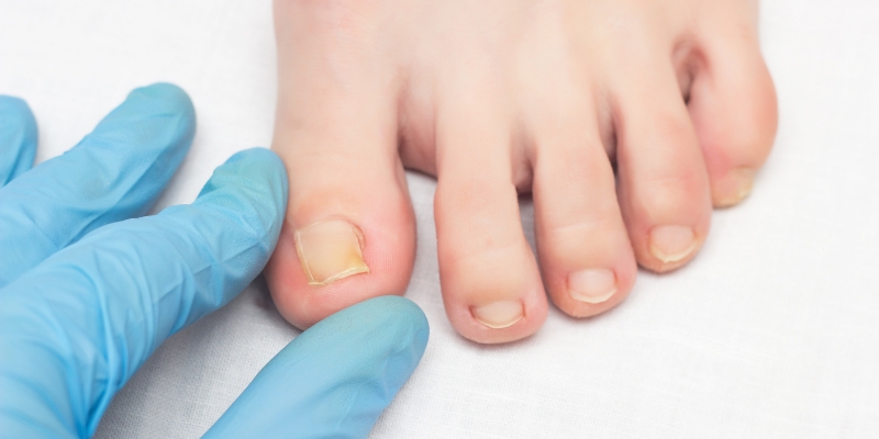 Nail Fungus Acupuncture Clinic Near Me